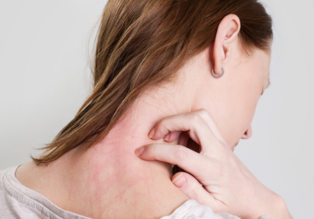 El eczema y consejos prácticos para combatirlos.